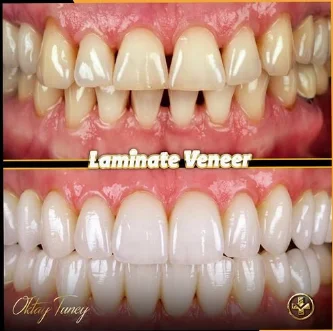 Laminate veneer
