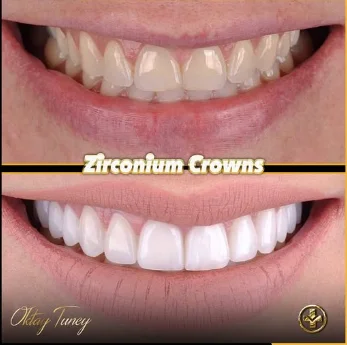 Zirconium crowns