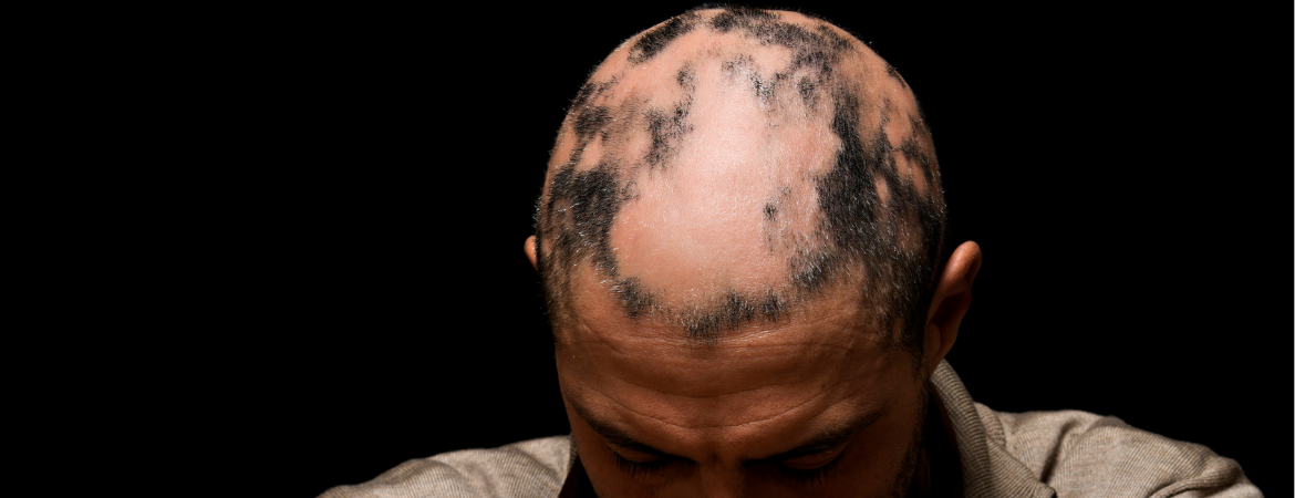 Alopecia (Tigna)