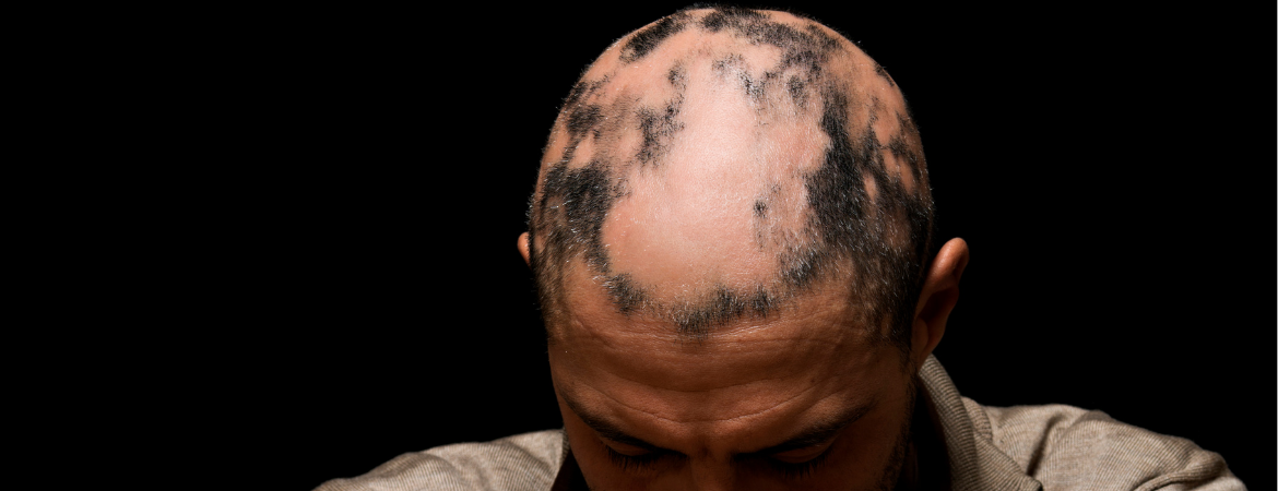 Alopecia