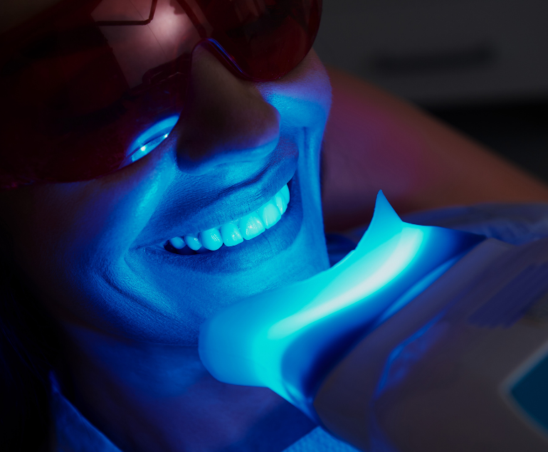 Blanchiment des dents