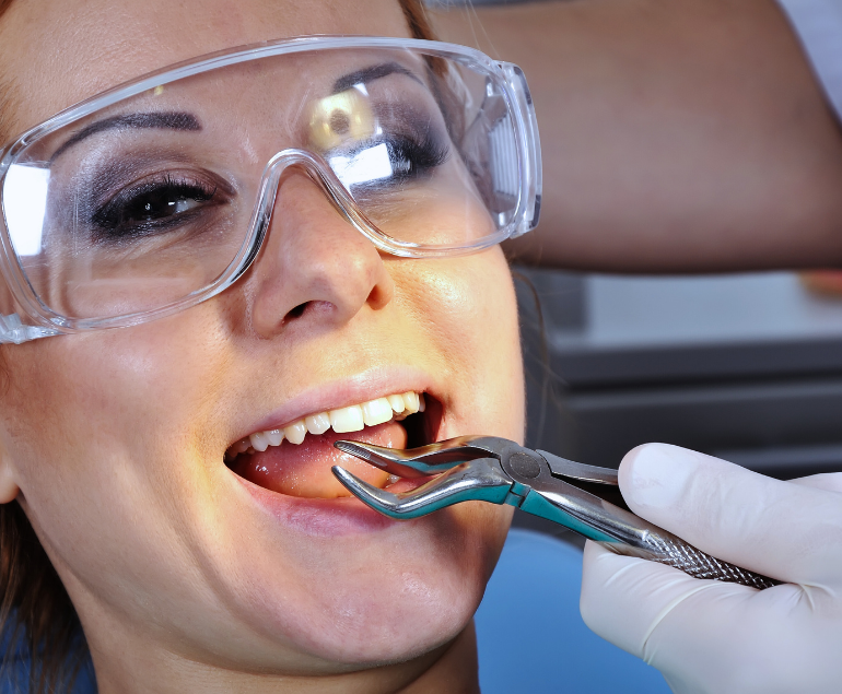 Estrazione del dente