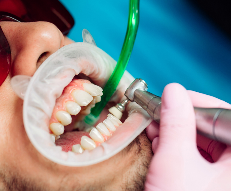 Teeth Cleaning