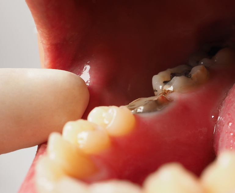 Root Canal Treatment