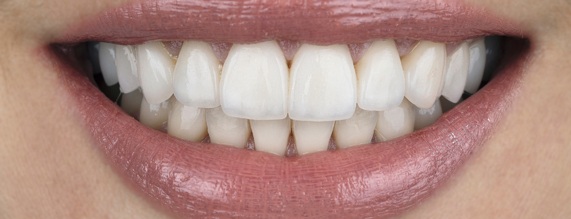 Rivestimento dentale in zirconia