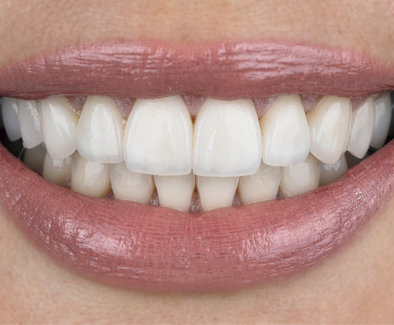 Rivestimento dentale in zirconia