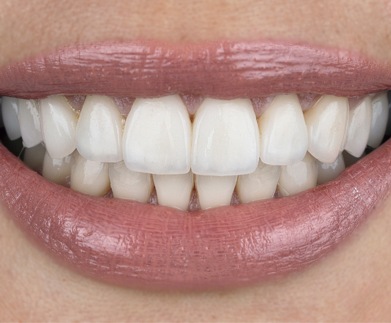Zirconium Dental Veneer