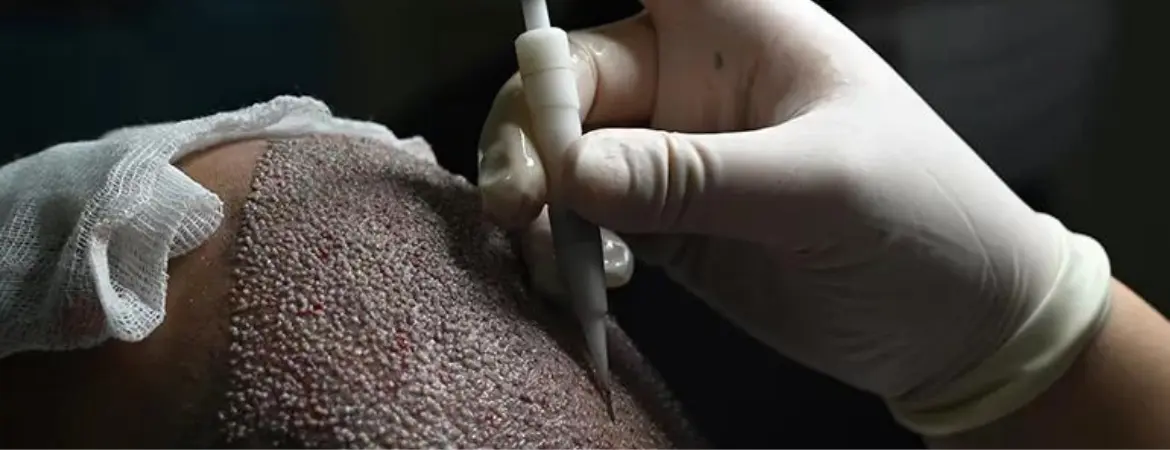 DHI-Hair-Transplant
